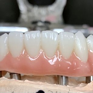 All-on-X prosthesis on a model