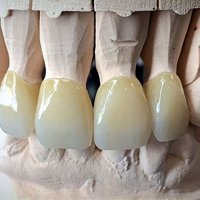 Close-up of anterior ceramic crowns