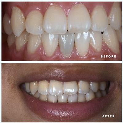Patient smile before and after: masking a dark stump