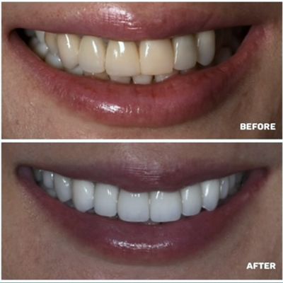 Patient smile before and after: shade change to a brighter white