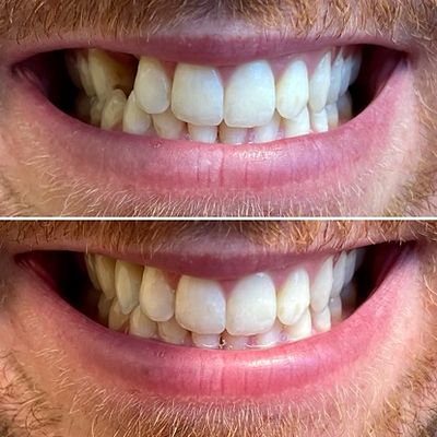 Patient smile before and after: replacing missing tooth #6