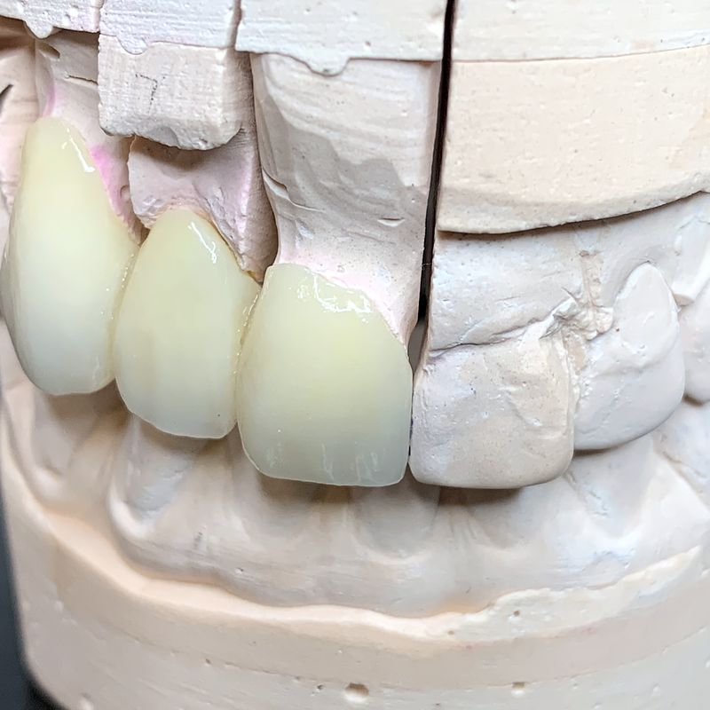 Ceramic crown and bridge restorations on a stone model