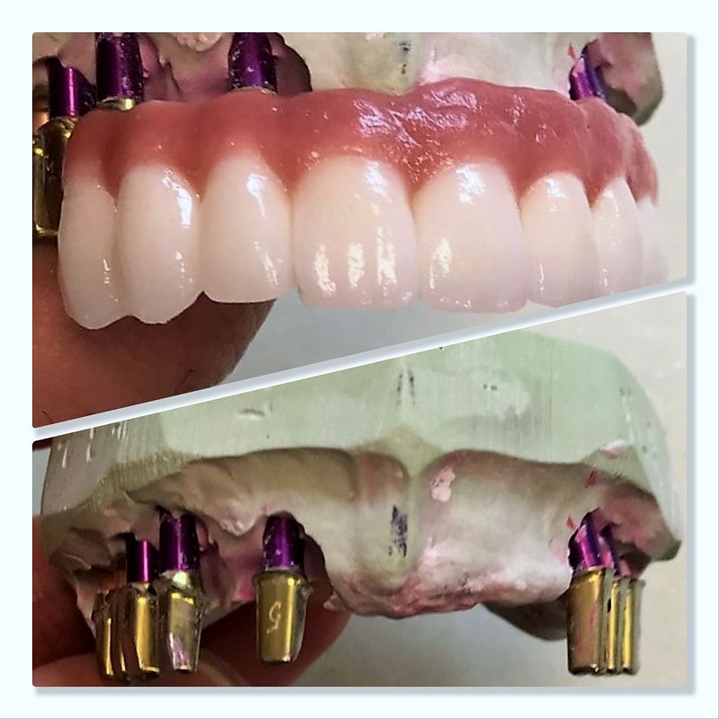 Full-arch implant restoration with pink gingival ceramic on implant analogs