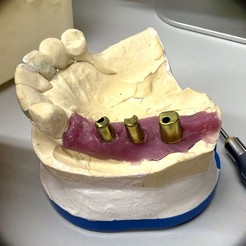 Custom milled implant abutments on a stone model