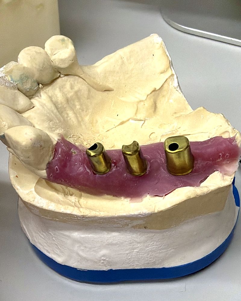 Custom milled implant abutments on a stone model with pink soft-tissue insert