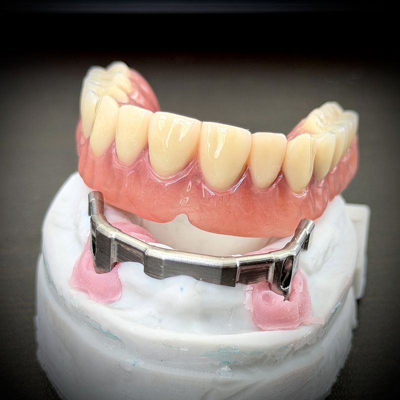 Implant overdenture seated on a bar over a stone model