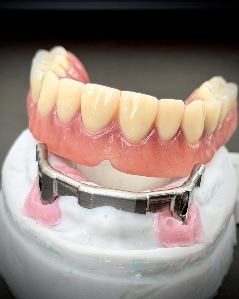 Implant overdenture seated on a bar over a stone model