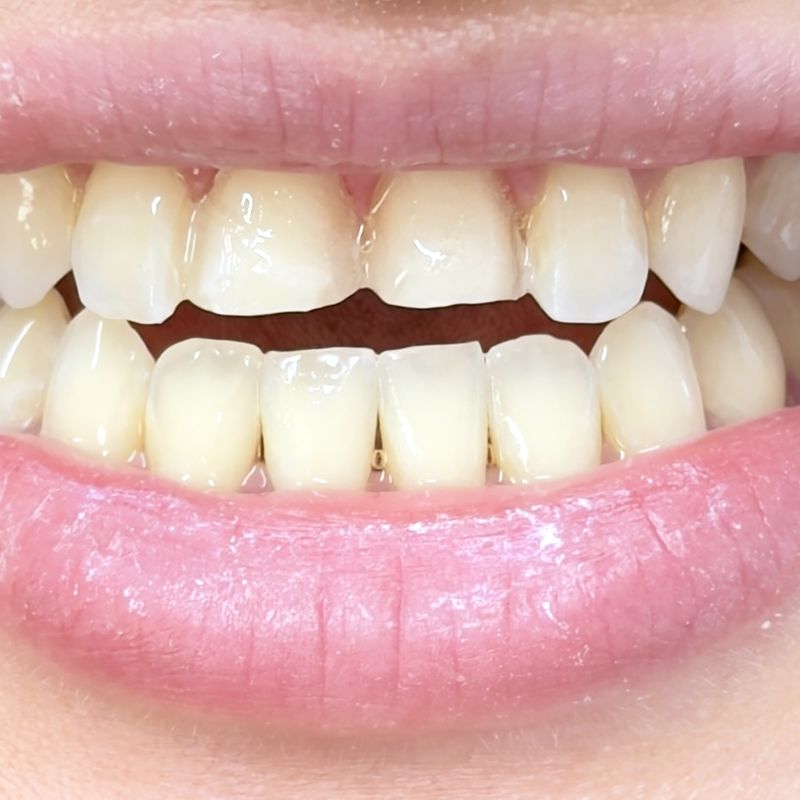 Close-up of veneer preparations, lips and teeth only