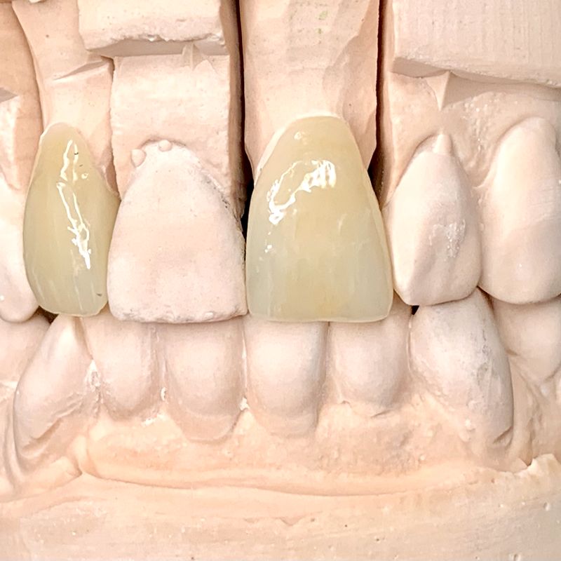 Anterior ceramic restorations on a sectioned stone model, one shade-matched crown among natural-colored dies
