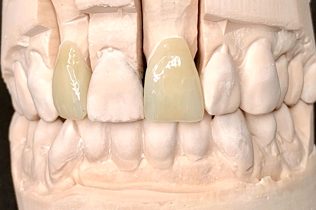 Anterior ceramic restorations on a sectioned stone model