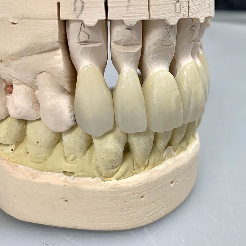 Two esthetic zirconia crowns on a stone model